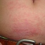 Что такое аллергия: определение, описание, фото Что такое аллергия: определение, описание, фото