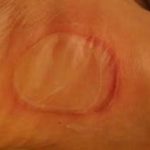Чем лечить мокрые мозоли на ногах в домашних условиях Чем лечить мокрые мозоли на ногах в домашних условиях