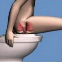 Эрозивный проктит: описание и признаки