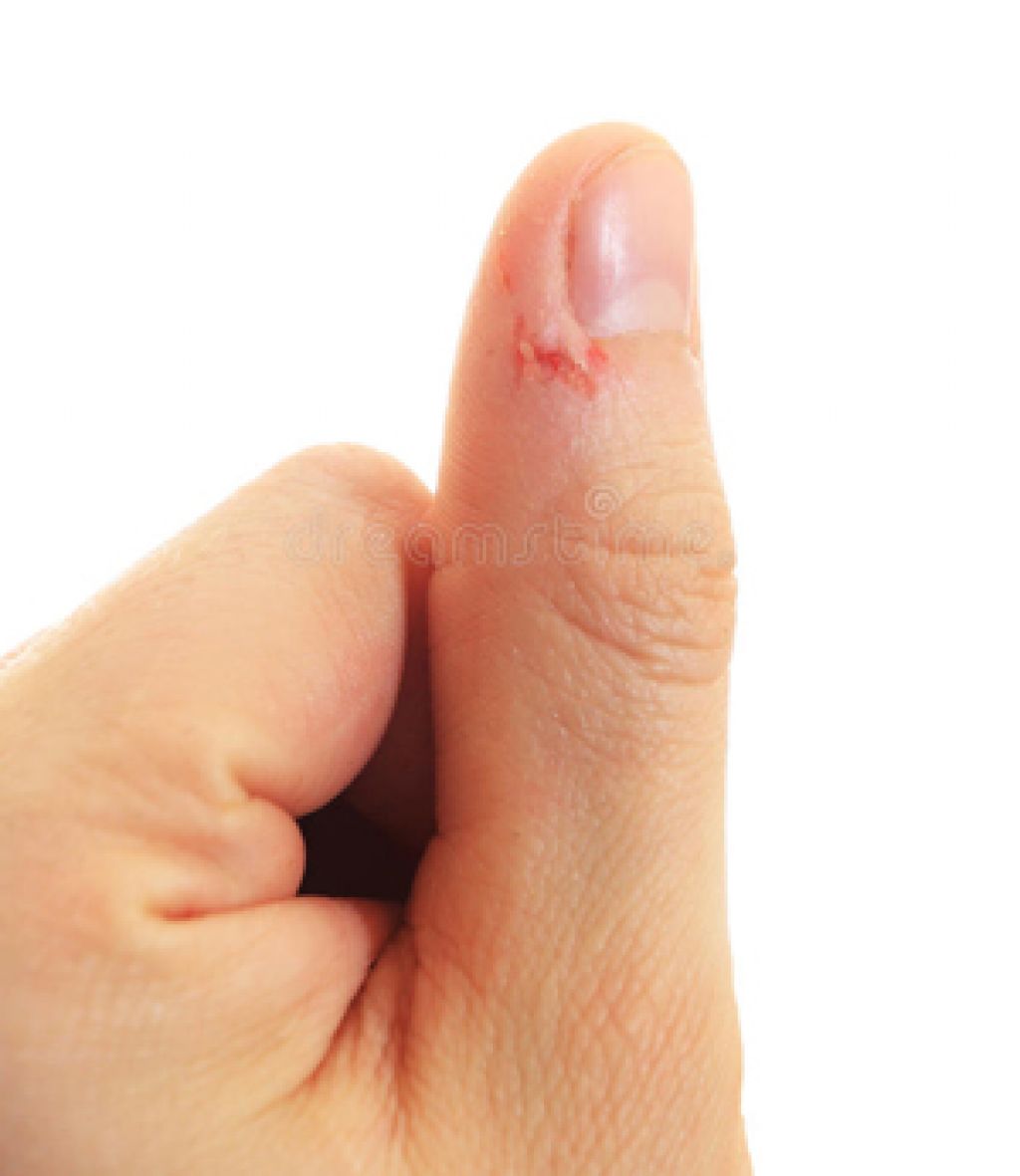 Трещины на пальцах возле ногтей