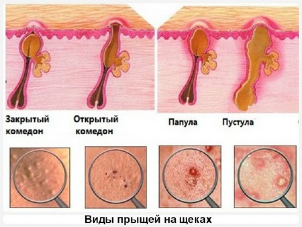 Anus fungal infection