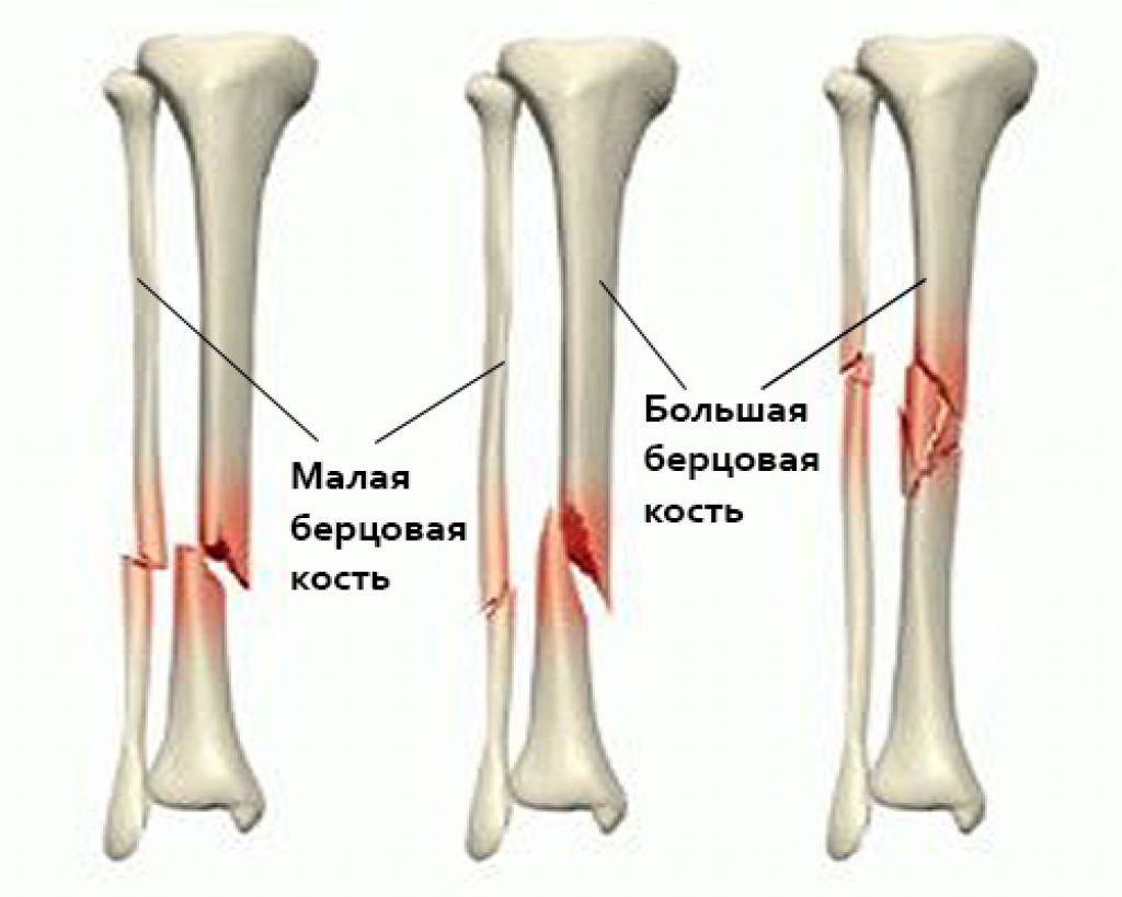 Большеберцовая кость где находится у человека фото на ноге