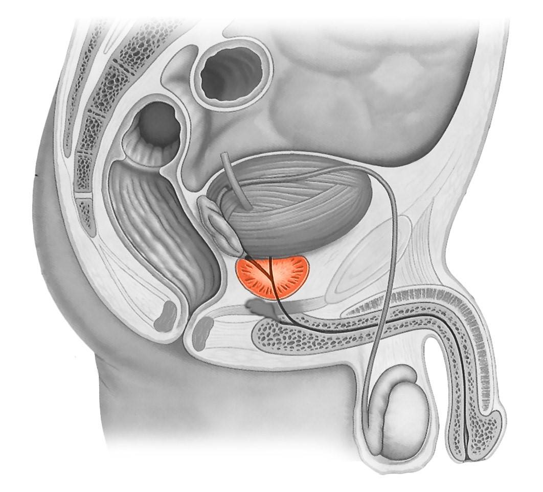 Мужская простата. Предстательная железа, Prostata. Простата и предстательная железа. Простатит предстательной железы. Железы предстательной железы.