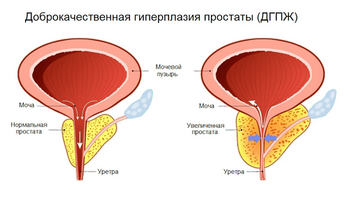 Какая должна быть предстательная железа размеры. Норма предстательной железы. Объем предстательной железы в норме. Нормальный размер простаты у мужчин. Объем простаты по возрасту таблица.