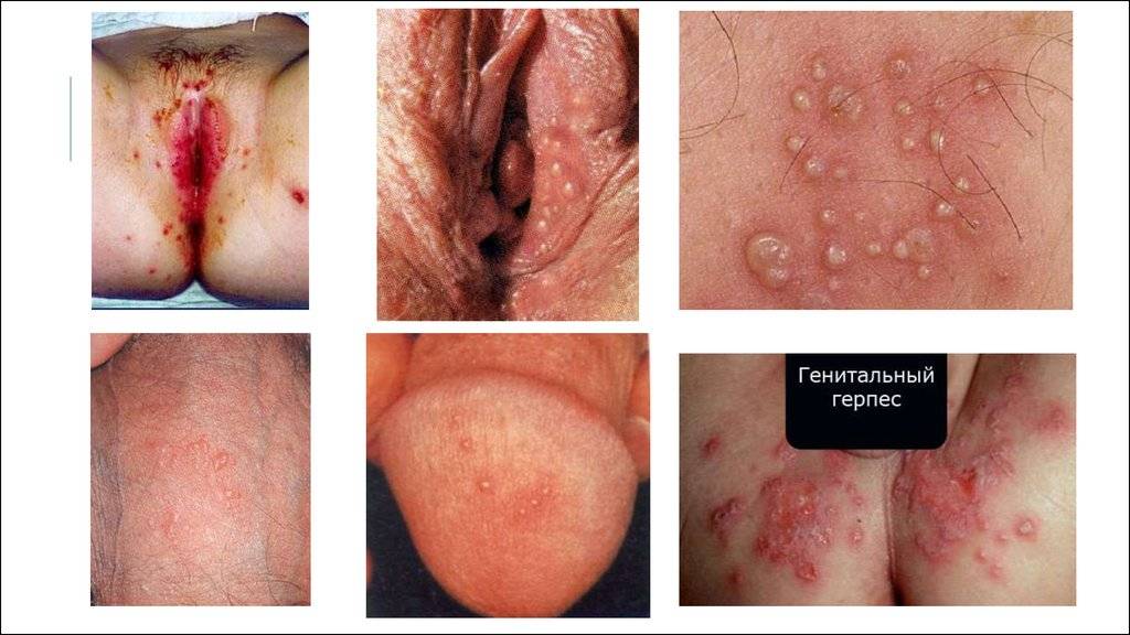 Herpes narbe geht nicht weg - 🧡 What is Herpes Simplex? (with pictures) .