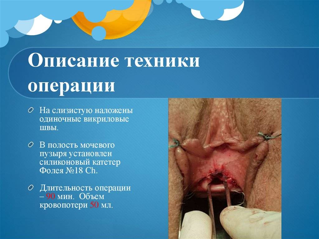 Для чего нужен расширитель уретры для мужчин