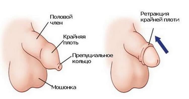 Интимная гигиена малыша: как правильно подмывать мальчика