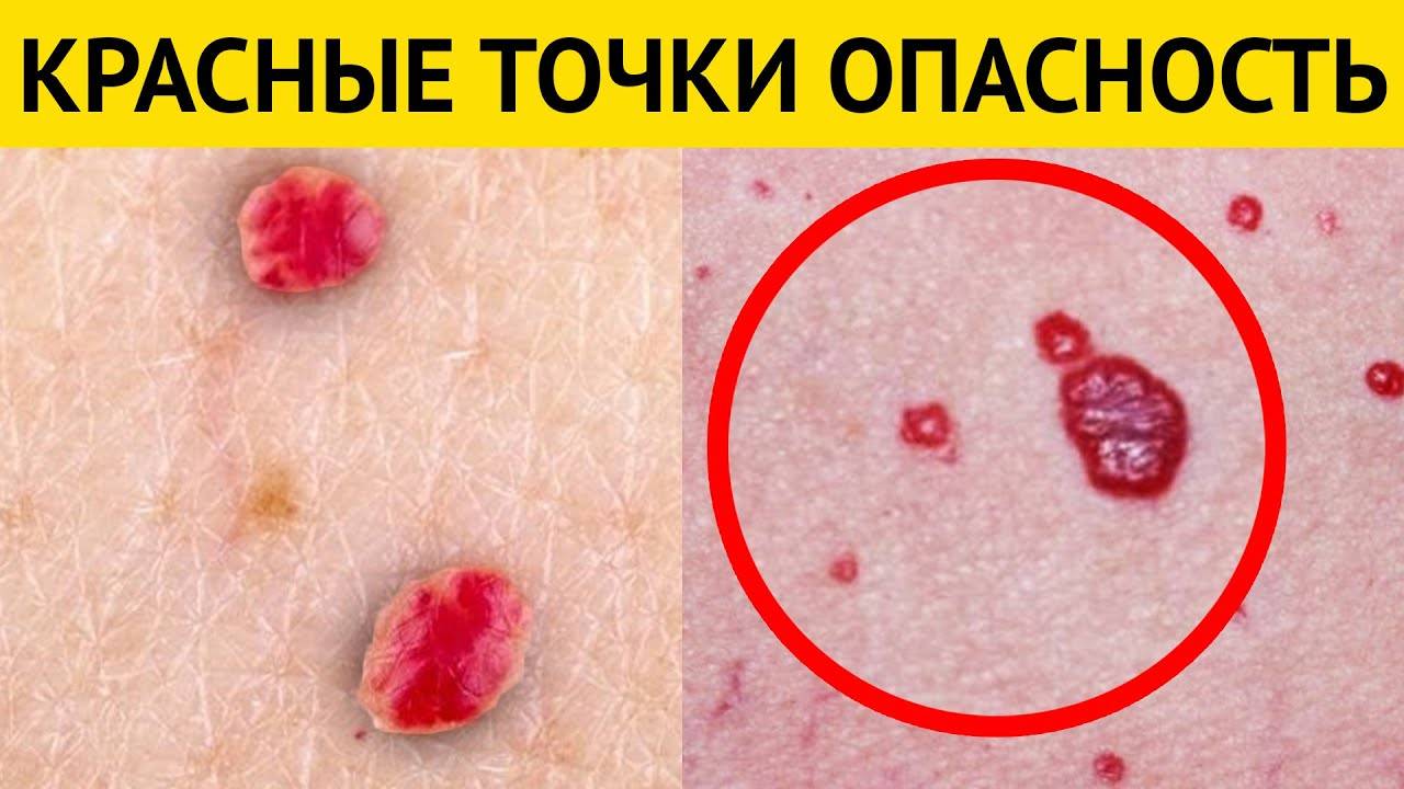 Что делать если папиллома воспалилась и покраснела: опасность и методы лечения