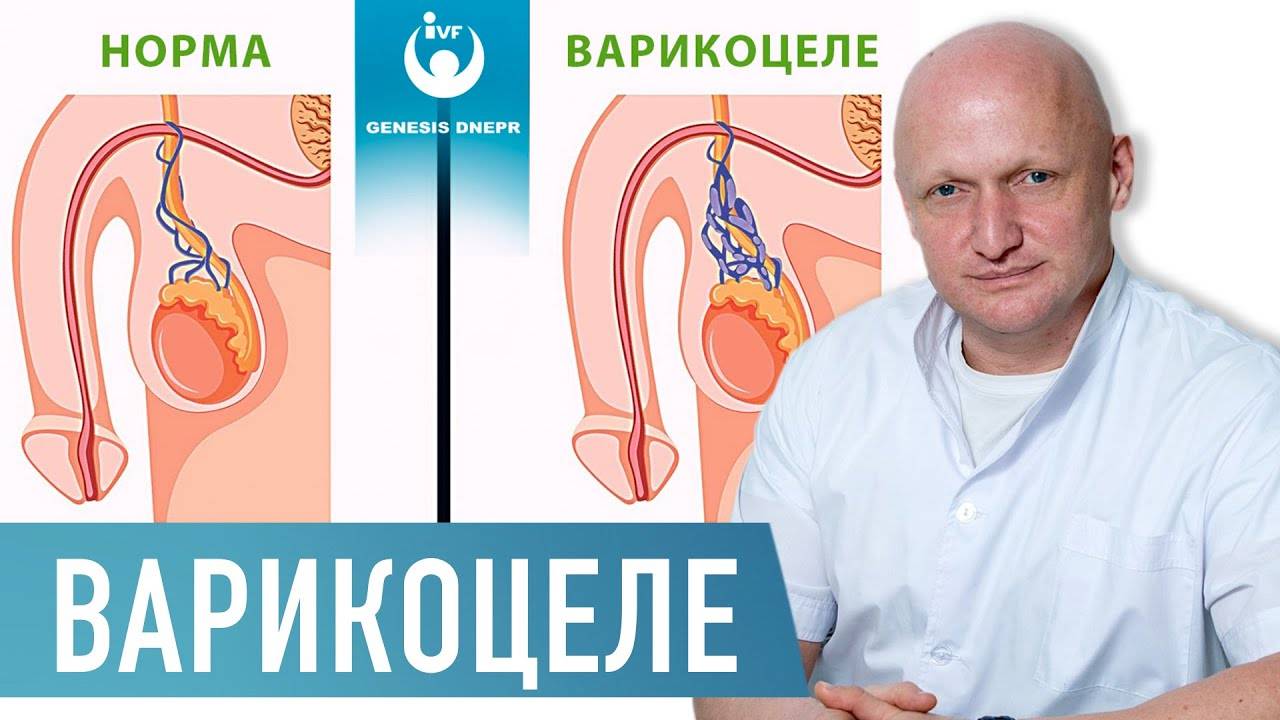 Этапы развития и методы лечения варикоцеле у мужчин
