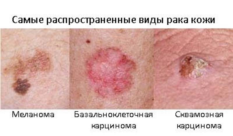 Меланома кожи: прогнозы жизни, фото начальной стадии, симптомы и признаки, диагностика и лечение