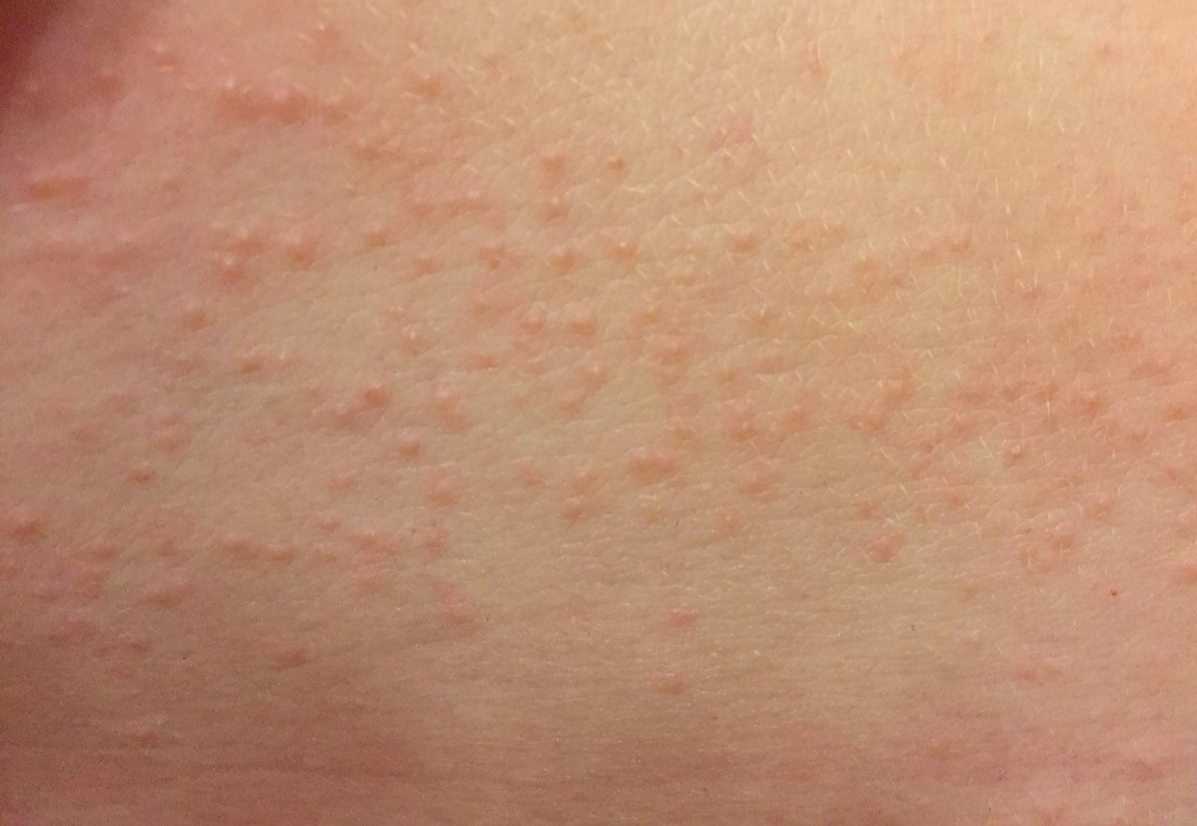 Прыщи у ребенка
