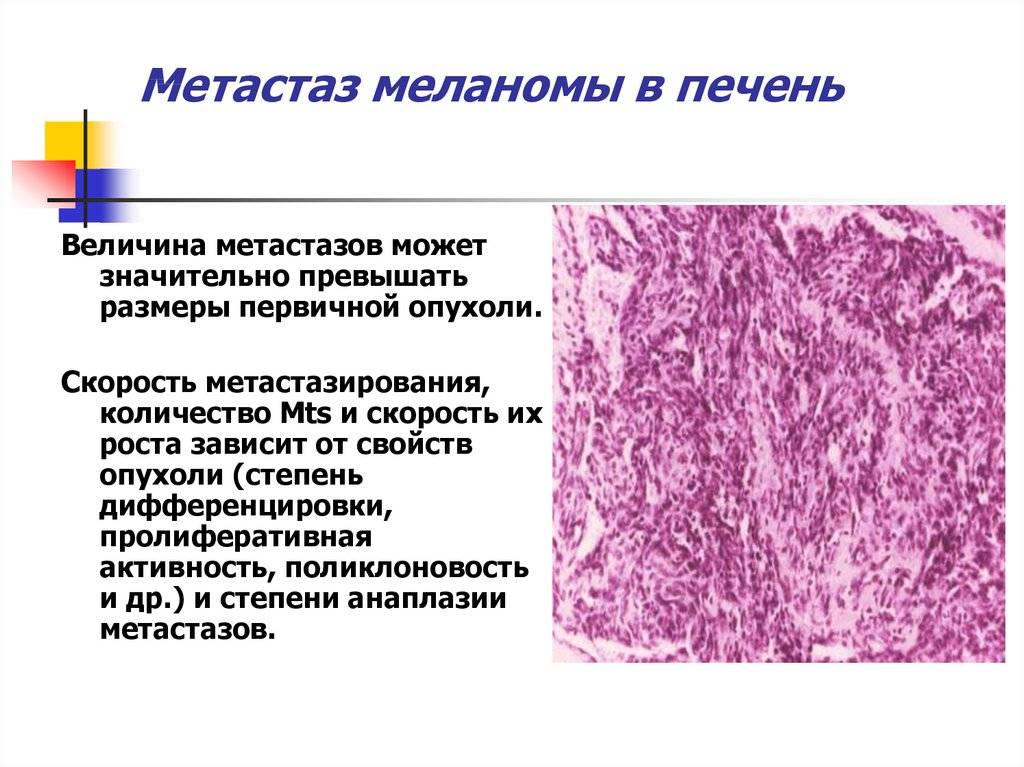 Метастазы меланомы в лимфоузел