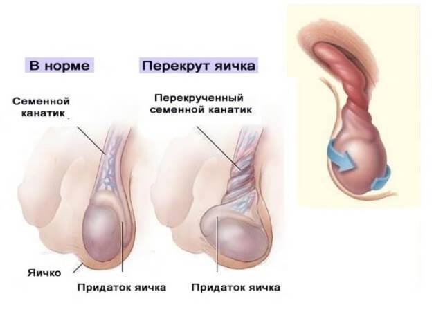 Причины уплотнения в яичке у мужчин
