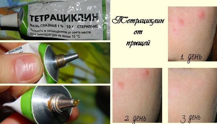 Тетрациклин от прыщей