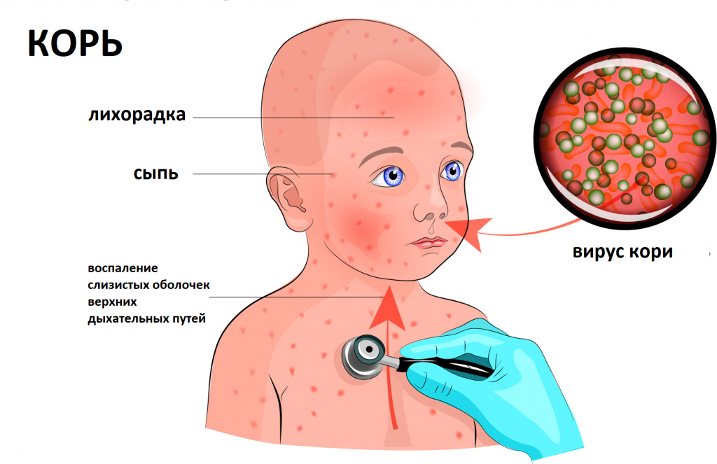 Картинки болезни краснухи