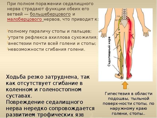 Фото седалищного нерва в ягодице