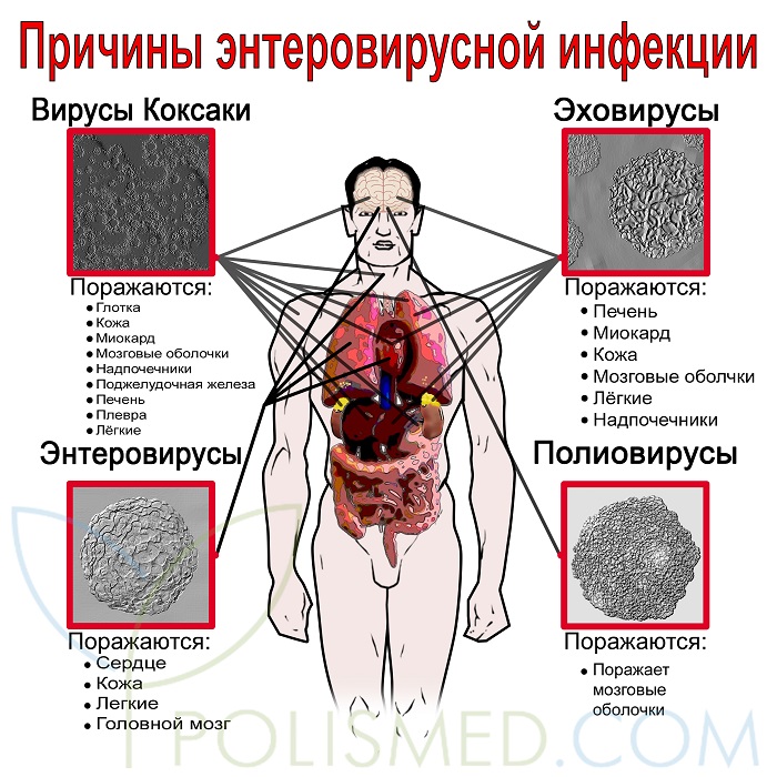 Энтеровирусная инфекция у взрослых фото