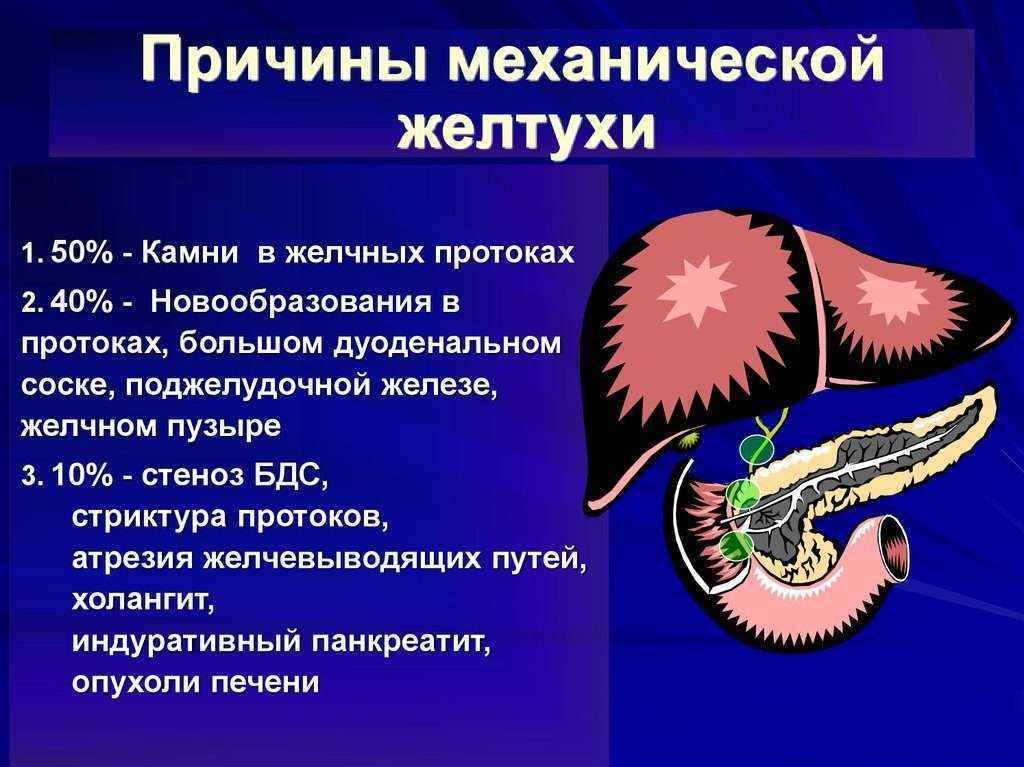 Желтуха мкб. Механическая желтуха. Механическая желтуха симптомы. Клинические проявления механической желтухи. Механическая желтуха желчных проток.