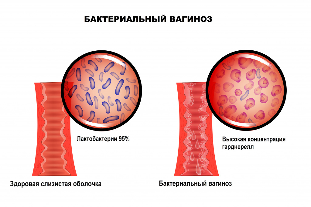 Схема лечения гарднереллеза у мужчин