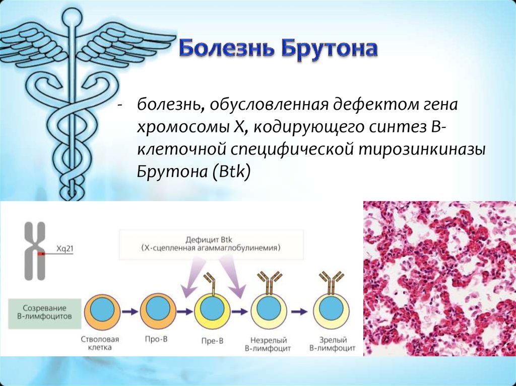 Боковой амиотрофический склероз неврология презентация