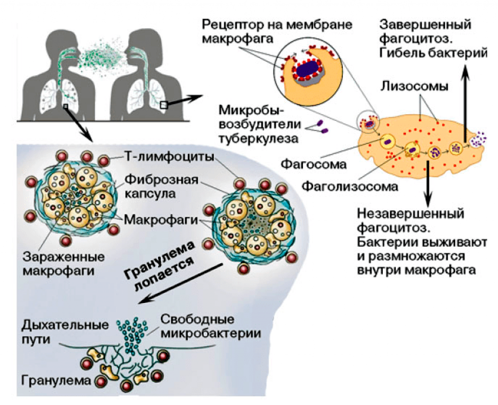 Активность макрофагов. Жизненный цикл туберкулезной бактерии. Антигенная структура микобактерий туберкулеза. Патогенез (фагоцитоз) туберкулеза. Структура микобактерии туберкулеза.