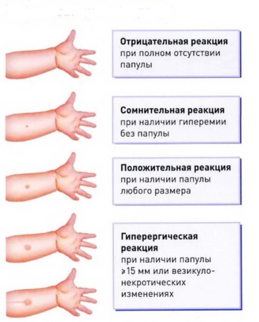 Диаскинтест взрослым. Реакция манту норма у детей. График манту для детей.