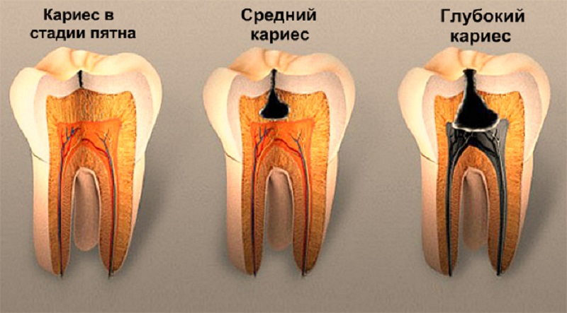 Стадии кариеса зубов фото