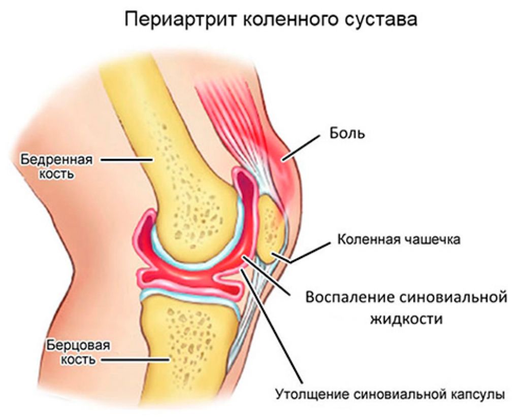 Синовит коленного сустава травма