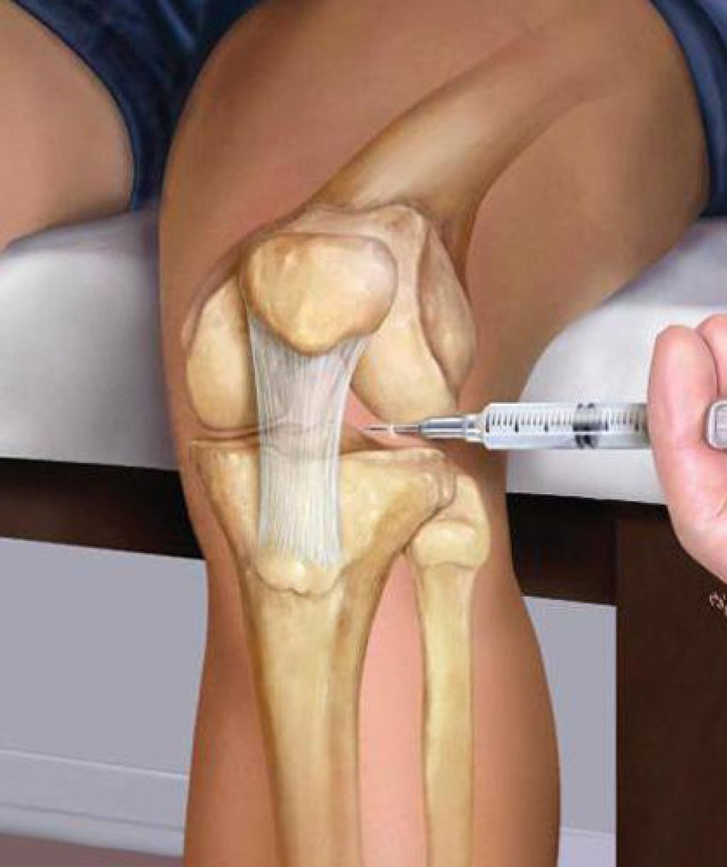 Восстановление сустава без операции. Плазмотерапия коленного сустава. Внутрисуставные блокады коленного сустава. Синовит артроз коленного сустава.