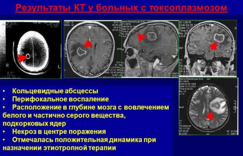 Внутриутробное поражение головного мозга. Токсоплазмоз на кт головного мозга. Форму поражения мозга при токсоплазмозе. Кт головного мозга при токсоплазмозе. Токсоплазмоз головного мозга мрт.