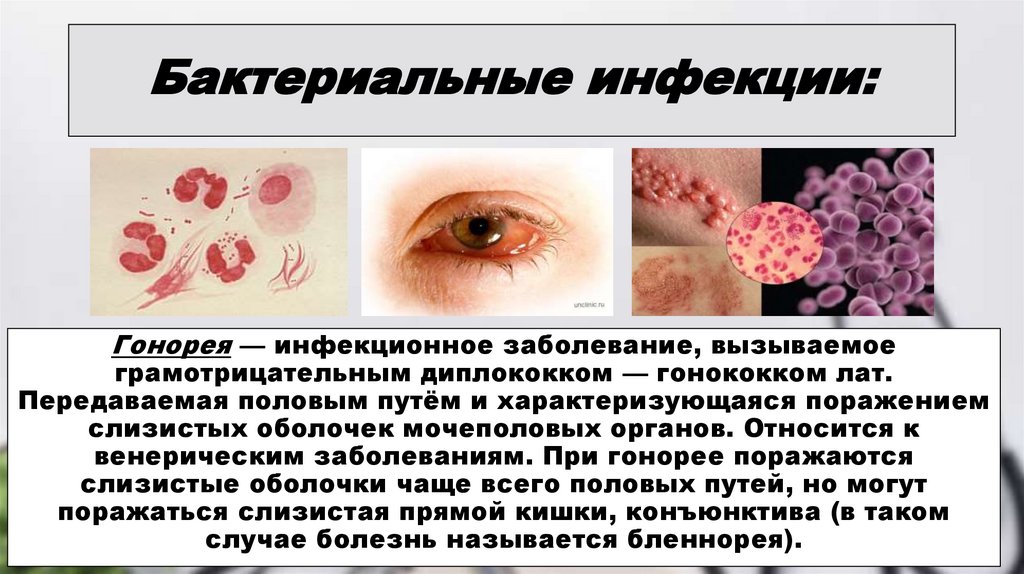 Инфекции передающиеся половым путем картинки