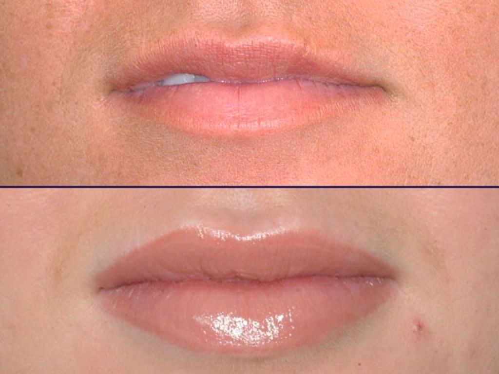 Татуаж или увеличение губ. Асимметрия губ до и после. Коррекция асимметрии губ. Исправление асимметрии губ филлером.