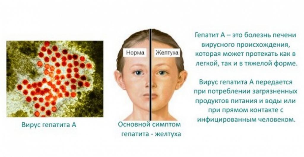 Признаки заболевания гепатитом. Болезнь вирусный гепатит. Вирусный гепатит симптомы у детей.