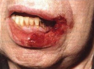 Туберкулез слизистой оболочки полости рта