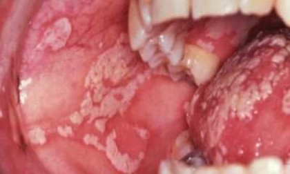 Туберкулез слизистой оболочки полости рта