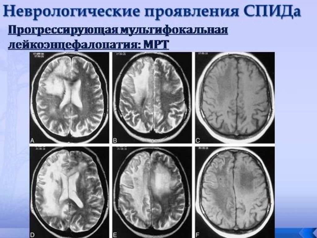 Многоочаговое поражение мозга. Мультифокальная лейкоэнцефалопатия. Мультифокальная лейкоэнцефалопатия головного мозга на кт. Прогрессивная мультифокальная лейкоэнцефалопатия мрт. Мрт мозг мультифокальная лейкоэнцефалопатия.