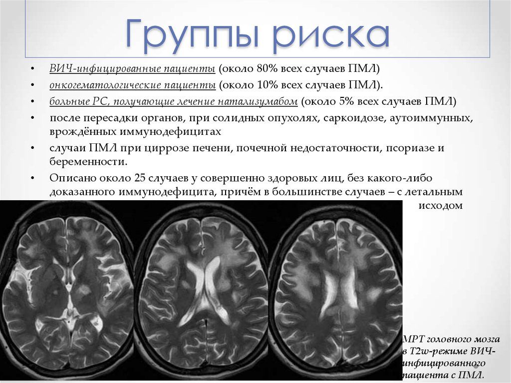 Сосудистый очаг в головном мозге что это. Прогрессирующая мультифокальная лейкоэнцефалопатия (ПМЛ). Прогрессирующая мультифокальная лейкоэнцефалопатия мрт. Лейкоэнцефалопатия головного мозга кт. ПМЛ мрт прогрессирующая мультифокальная лейкоэнцефалопатия.
