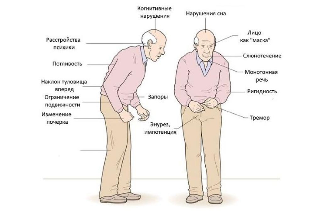 Болезнь паркинсона симптомы у мужчин и признаки