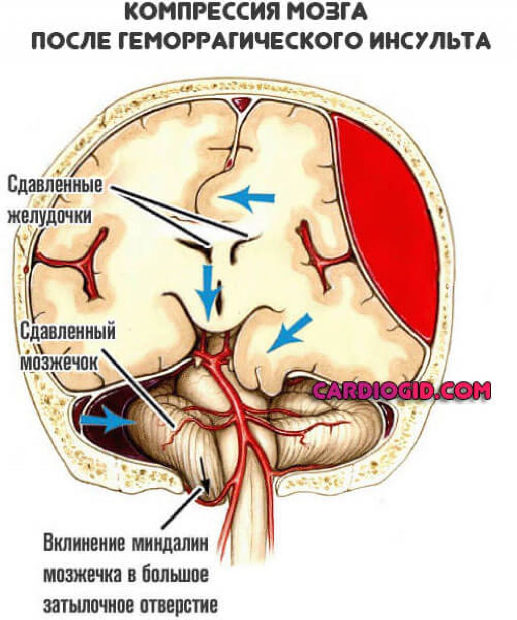 Инсульт левой артерии. Таламический геморрагический инсульт. Ишемический инсульт головного мозга. Вентрикулярный геморрагический инсульт. Ишемический инсульт поражения артерий.