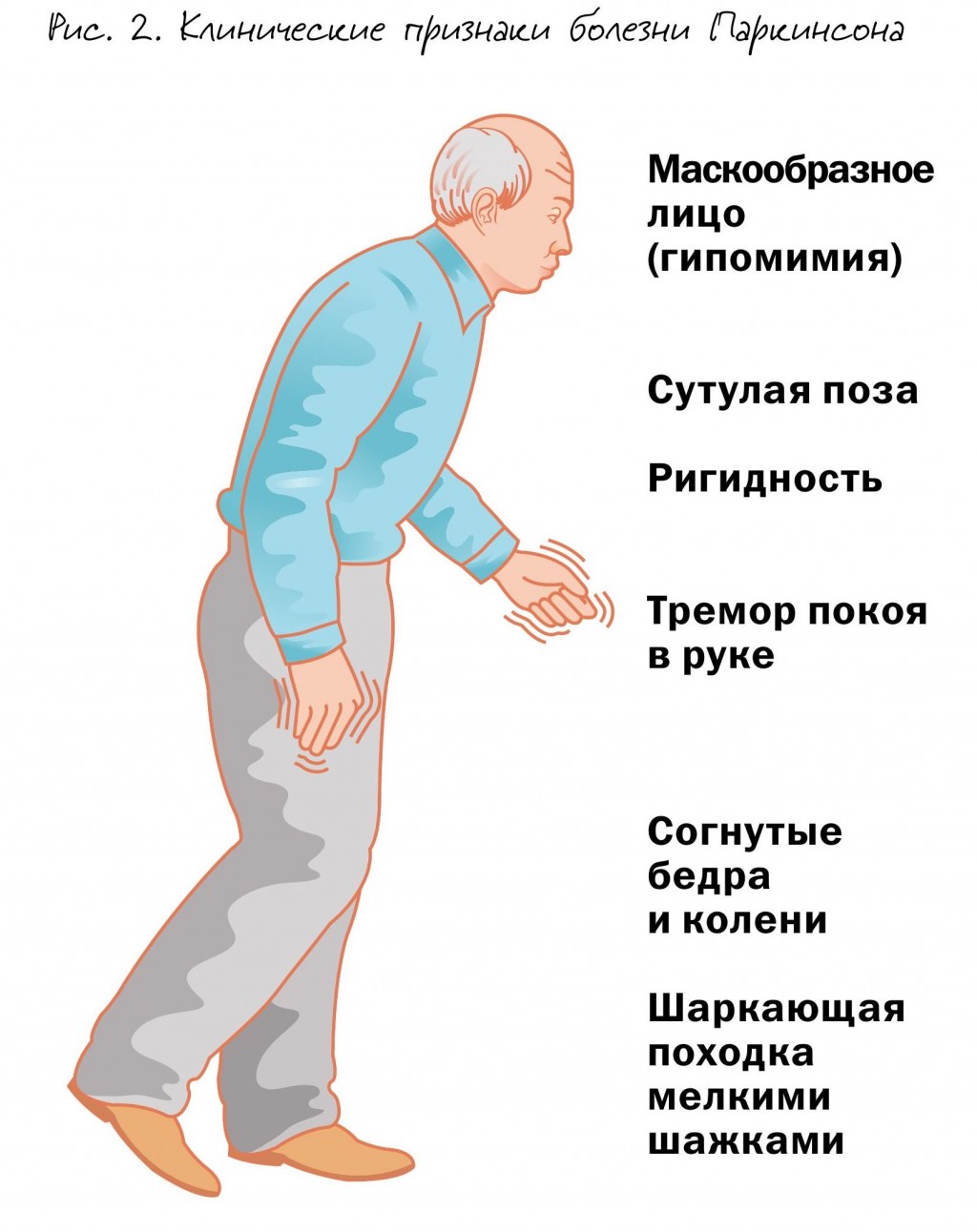 Руководство по лечению болезни паркинсона