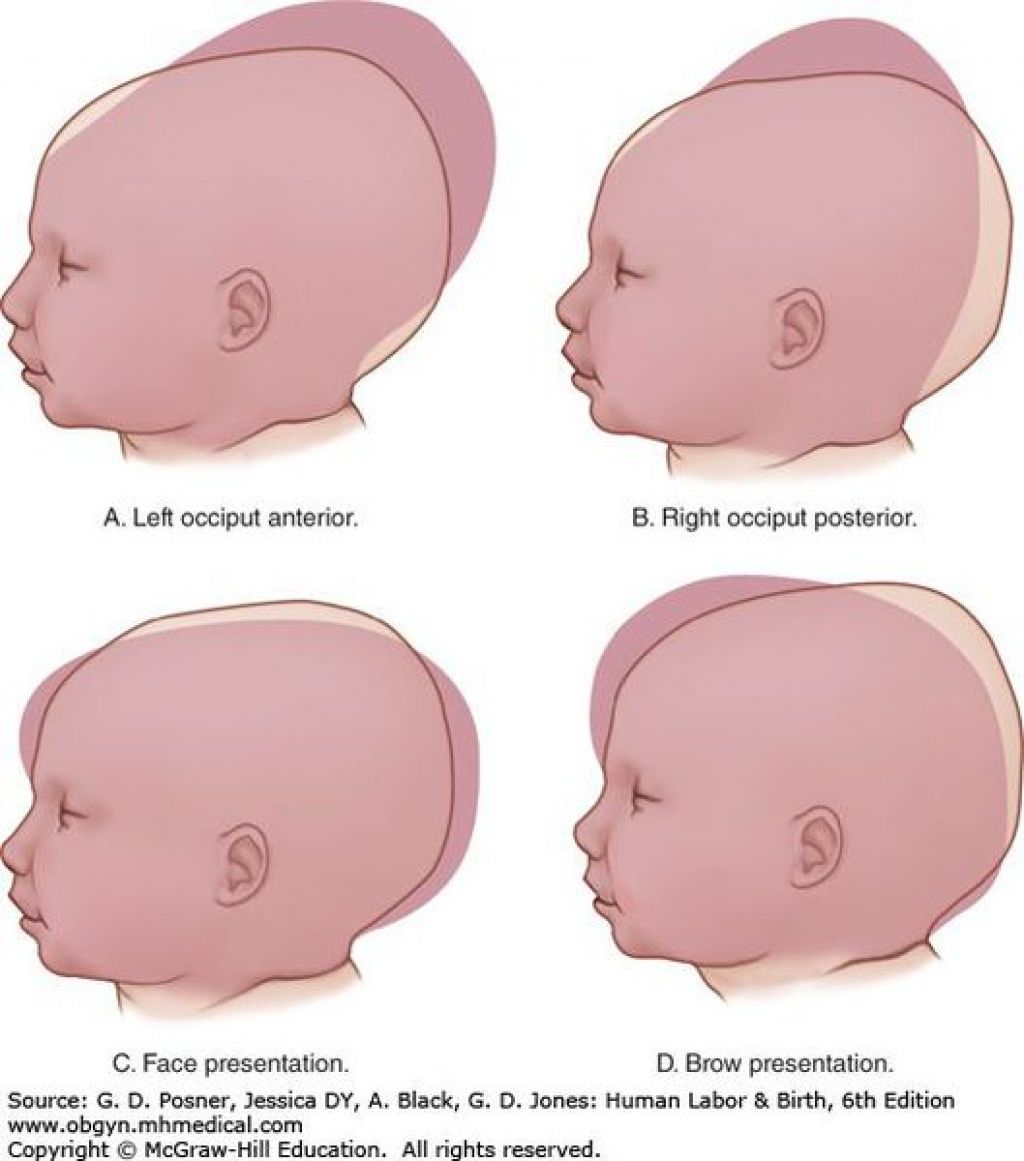 4 родничка. Долихоцефалическая форма головы у плода. Форма головы сбоку младенца. Кефалогематома кривошея.