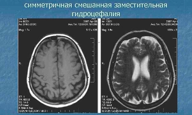 Картина наружной заместительной гидроцефалии