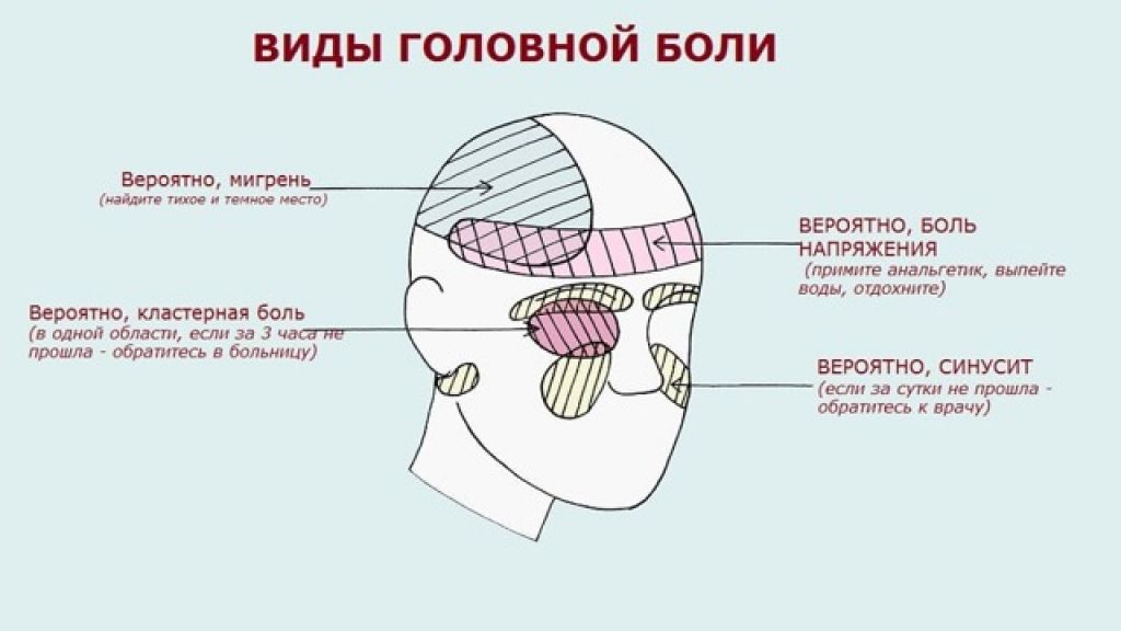 Болит череп сверху. Схема локализации головной боли. Классификация головной боли по локализации. Локализация глазной боли. Головная больлоклизация.