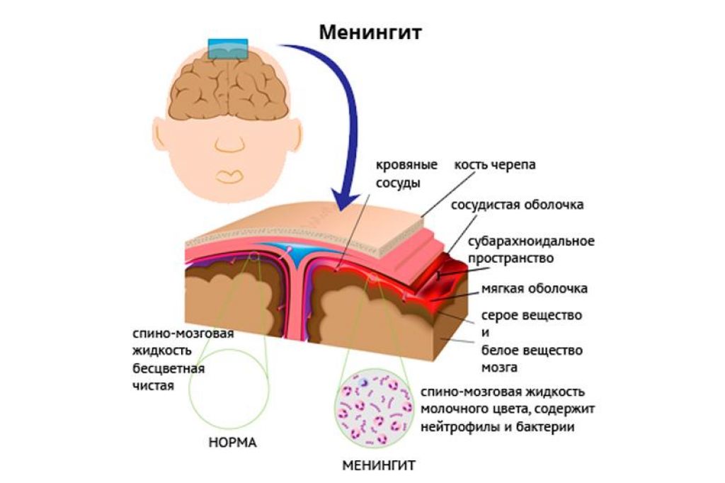 Менингит симптомы у детей. Менингит воспаление мозговых оболочек. Оболочка головного мозга менингит. Симптомы поражения мозговых оболочек при менингите. Менингит воспаление мозговых оболочек схема.