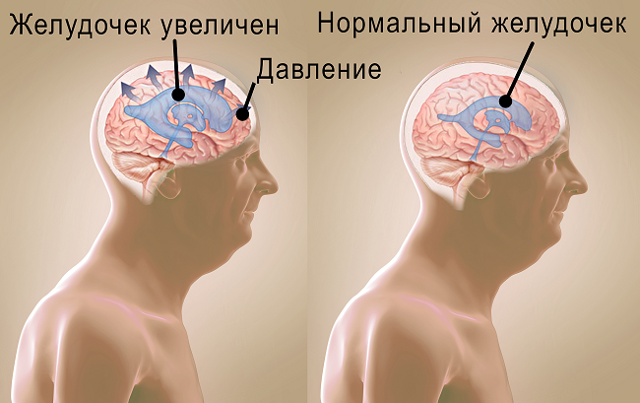 Гидроцефалия головного мозга у взрослого человека фото