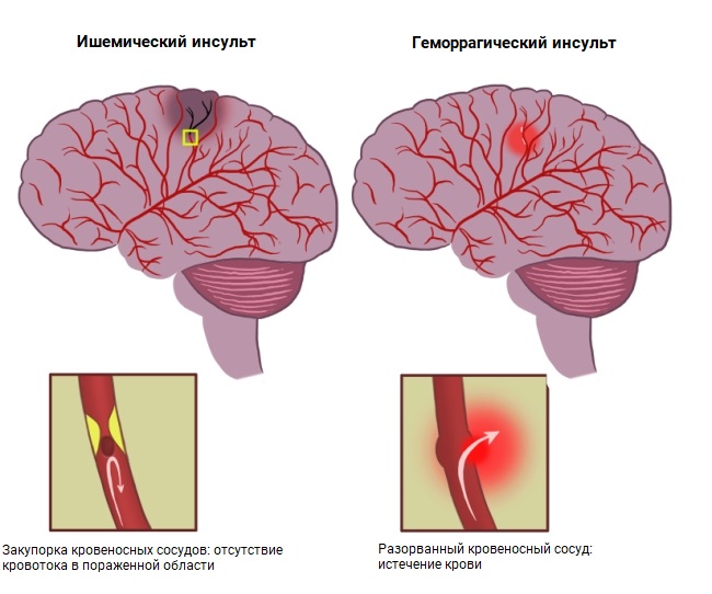 Ишемический инсульт и геморрагический инсульт картинки