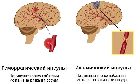 Ишемический инсульт и геморрагический инсульт картинки