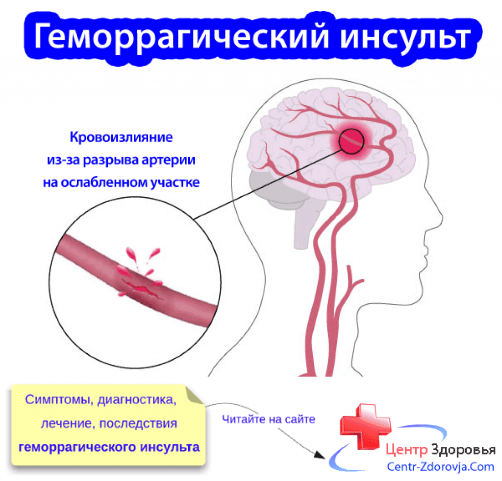 Кровоизлияние ствола мозга