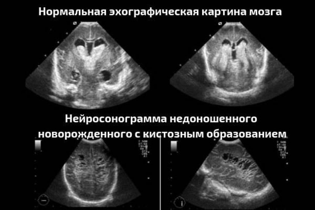 Узи мозга норма. УЗИ головного мозга у новорожденных норма и патология. УЗИ головы у грудничка нормы. Ультразвуковое исследование головного мозга - нейросонография (НСГ). Нейросонография новорожденных нормы 1.