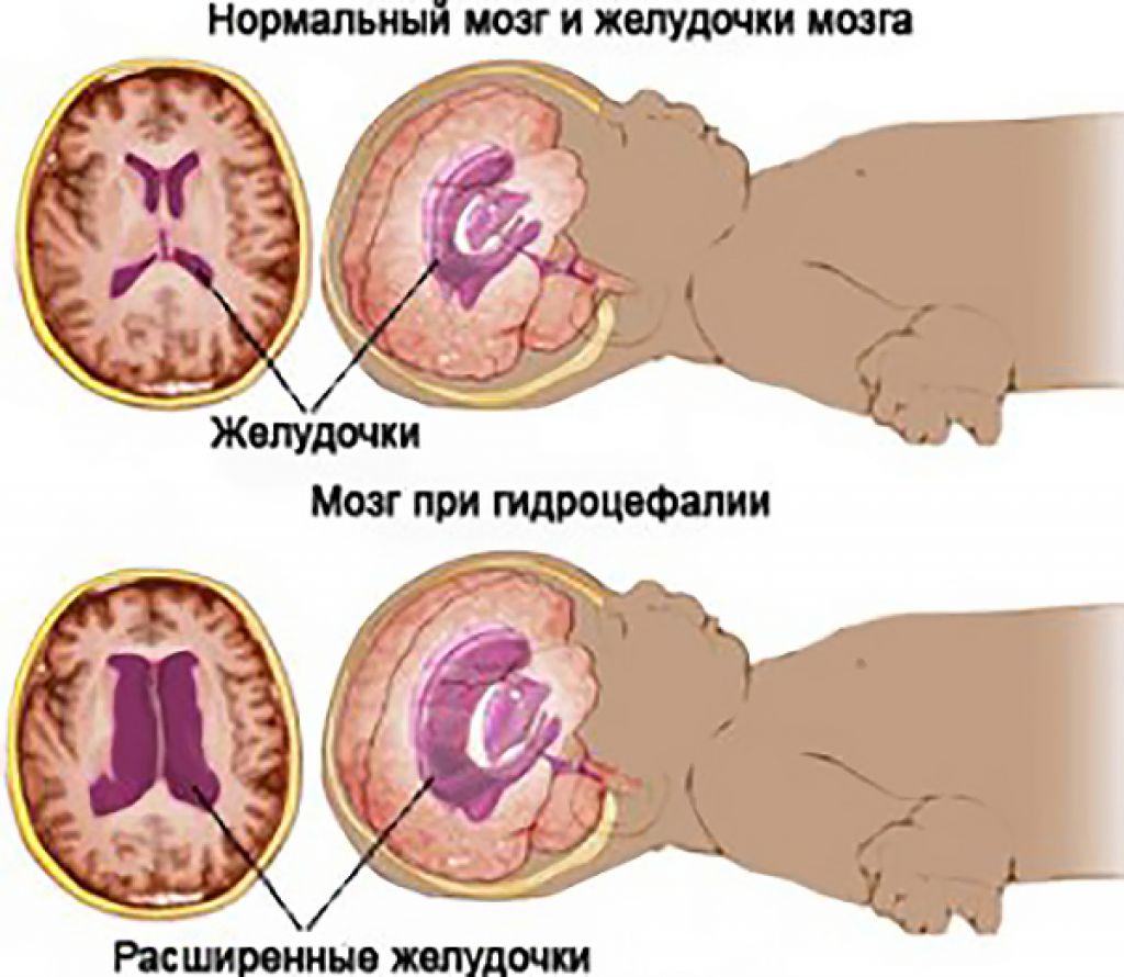 Дилатация бокового желудочка мозга
